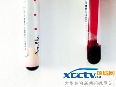 老人血液变牛奶白