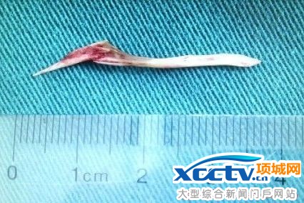 6厘米长鱼刺体内游荡